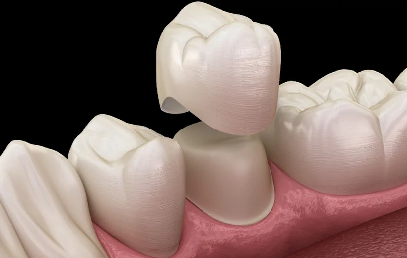 Corone in zirconio Albania